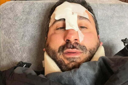 Brutto incidente per lo chef Natale Giunta caduto in una buca