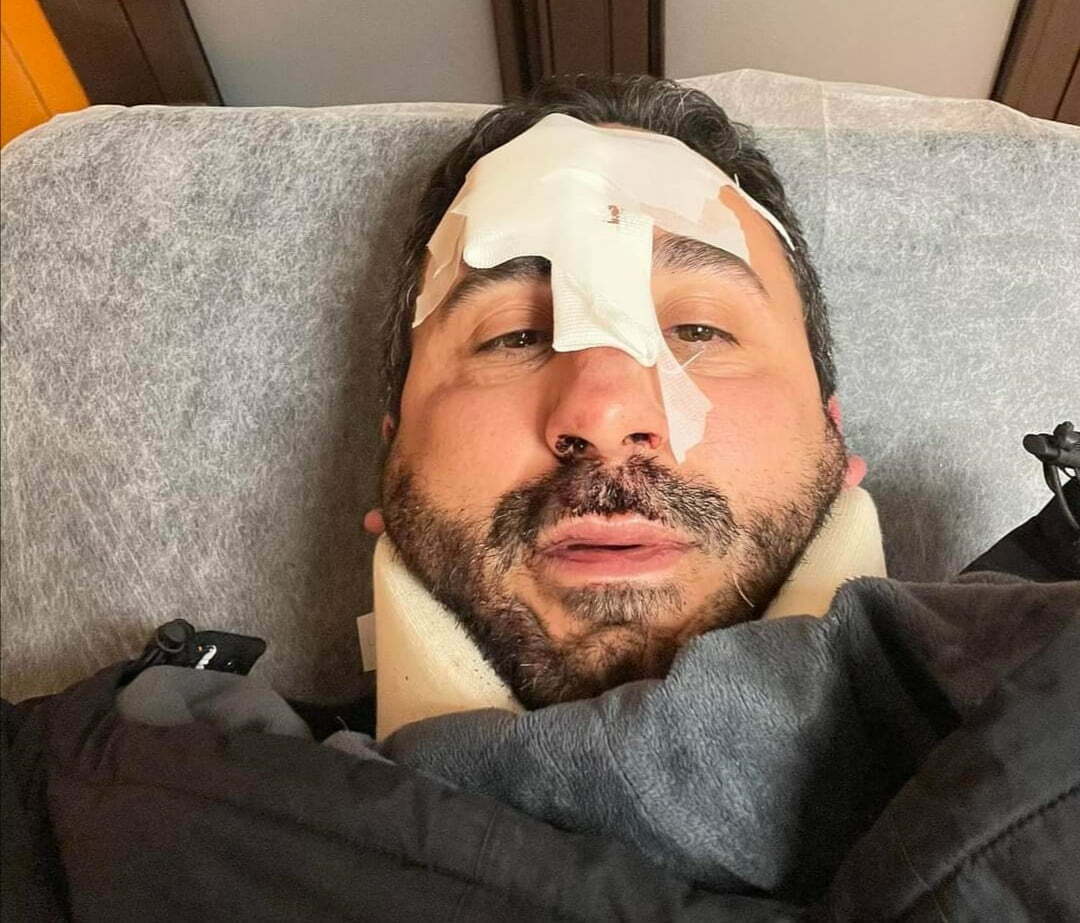 Brutto incidente per lo chef Natale Giunta caduto in una buca